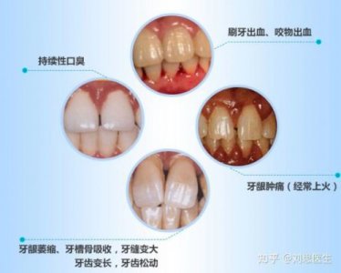 ​牙周炎是什么原因引起的(牙周炎是什么引起的怎么治疗)