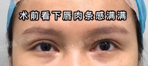 双眼皮修复价位是不是比第一次高(双眼皮修复手术价格)-第2张图片-