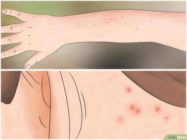 床虱咬过后的疙瘩图片(床虱咬过后的疙瘩怎么消除)