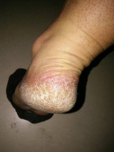 脚后跟干裂起硬皮裂口子怎么办（脚后跟干裂起硬皮裂口子如何缓解）