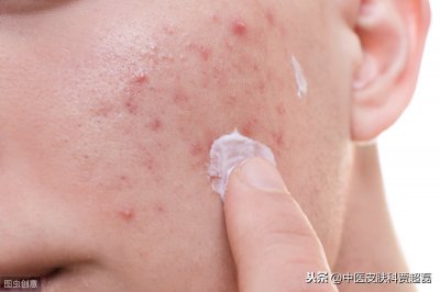 ​中医治疗痤疮 医生用了4种治疗思路，这才是中医治病的核心