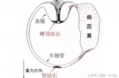 ​耳石自我复位法图解 眩晕不要忽略耳石症，手法复位显神通