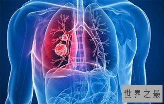 十大致命类型的癌症,都是很难治愈的癌症!