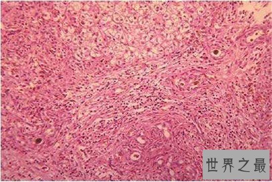 十大致命类型的癌症,都是很难治愈的癌症!