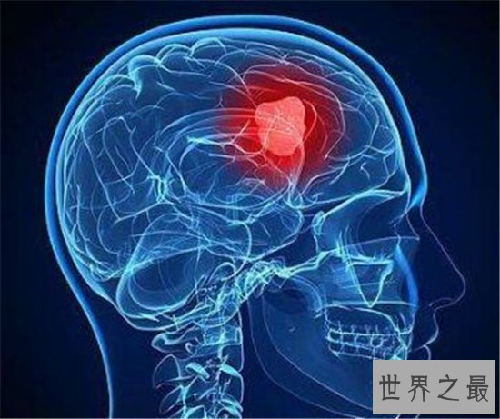 十大致命类型的癌症,都是很难治愈的癌症!