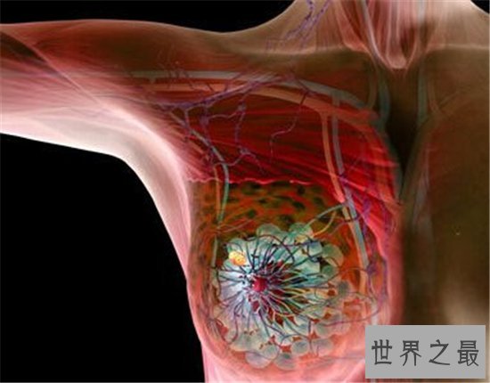 十大致命类型的癌症,都是很难治愈的癌症!