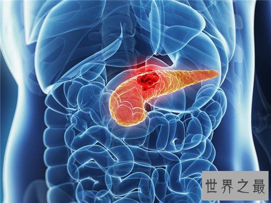 十大致命类型的癌症,都是很难治愈的癌症!