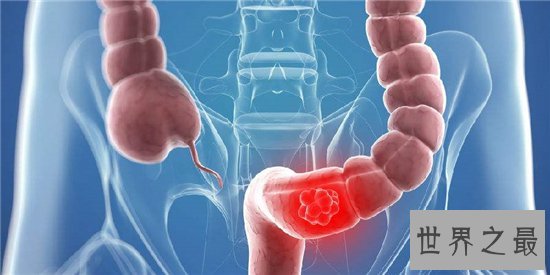 十大致命类型的癌症,都是很难治愈的癌症!