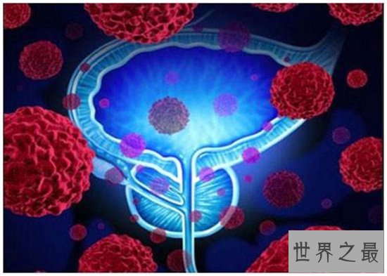 十大致命类型的癌症,都是很难治愈的癌症!