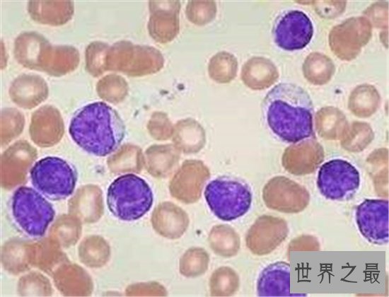 十大致命类型的癌症,都是很难治愈的癌症!