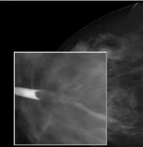 ​乳腺钼靶检查 什么是钼靶检查？钼靶检查有辐射吗？