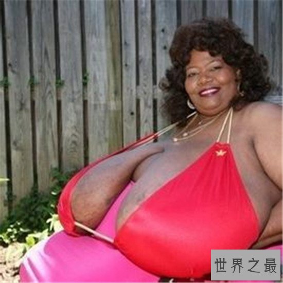 世界上最大的天然乳房,双乳重达77斤(图)