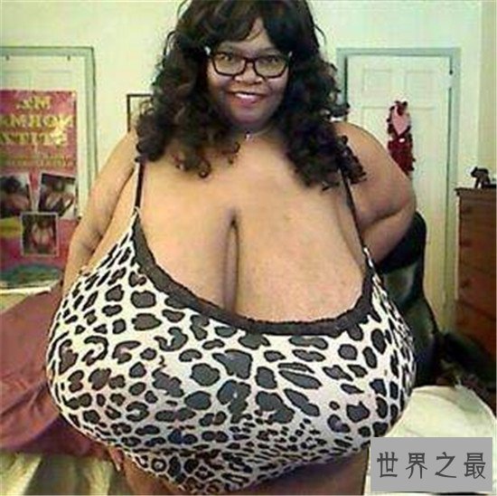 世界上最大的天然乳房,双乳重达77斤(图)