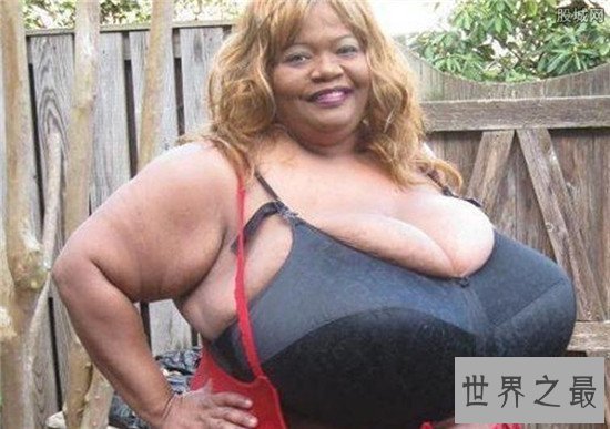 世界上最大的天然乳房,双乳重达77斤(图)