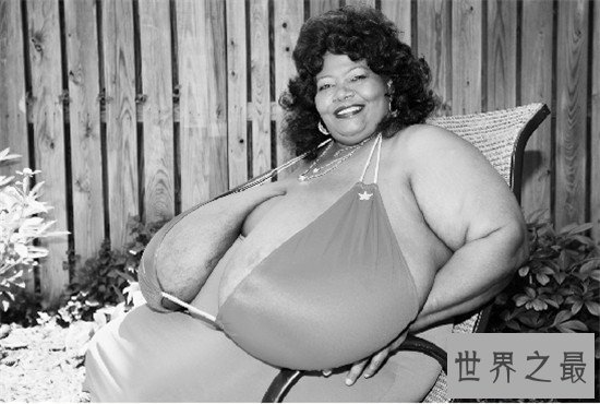 世界上最大的天然乳房,双乳重达77斤(图)