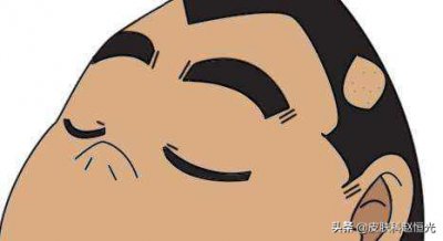 ​斑秃的原因和治疗方法 看毛发医生如何治疗斑秃