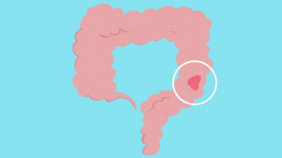 ​肠炎与肠癌最明显区别 慢性肠炎离大肠癌究竟有多远？