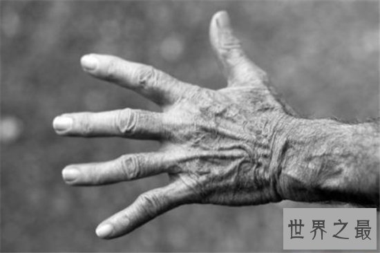 世界十大罕见病,到现在还没有解决的办法!