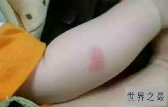 蚊子喜欢叮咬什么血型的人,看看你是不是蚊子最喜欢的那个人。