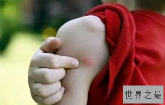 蚊子喜欢叮咬什么血型的人,看看你是不是蚊子最喜欢的那个人。