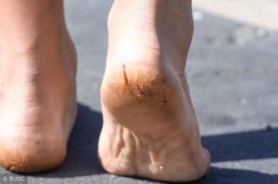 ​脚后跟干裂起硬皮怎么办有什么妙招 脚后跟干裂起硬皮怎样去除