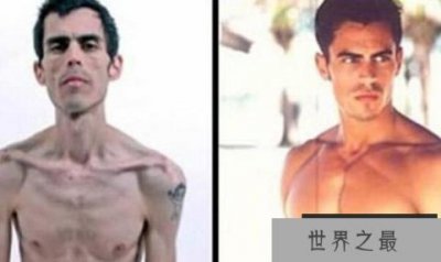​世界上最瘦的男人，患厌食症体重仅41公斤（瘦成竹竿）