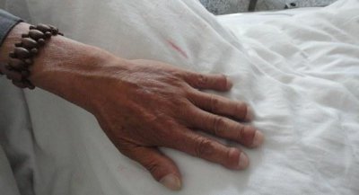 ​辟谣丨“杵状指”暗示肺癌早期？医生：肺癌晚期会出现这种症状