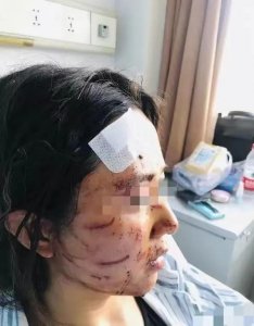 ​恶犬咬人的恶性事件频频发生？伤势严重令人痛心！