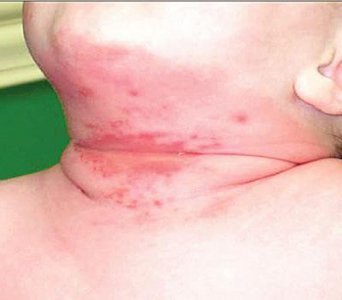 ​宝宝淹脖子发红又破皮，和家长护理方式关系最大，解决办法并不难