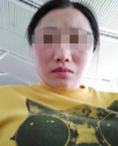 ​南昌：女子花12000元在“荣美会”做祛斑 她说“被严重毁容”了