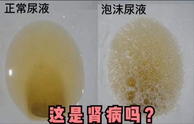 ​为何在撒尿时，会有泡沫？泡沫尿是肾病的专属标识？