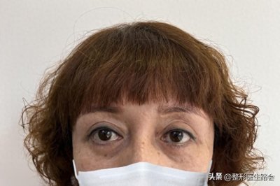 ​术后1年跟踪：50岁两次祛眼袋失败！靠＂膨体泪沟填充＂年轻10岁！